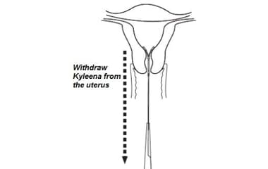 Illustration shows how to withdraw and remove Kyleena (levonorgestrel-releasing intrauterine system) 19.5 mg IUD from the uterus.