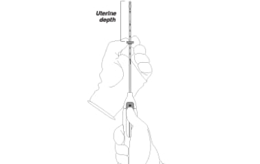 Illustration shows how to set the flange prior to IUD insertion.
