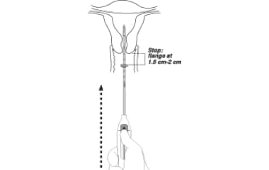 Illustration shows that Kyleena (levonorgestrel-releasing intrauterine system) 19.5 mg IUD is now ready to be inserted after the flange is set.