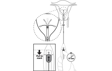 Illustration shows how to open the arms of Kyleena (levonorgestrel-releasing intrauterine system) 19.5 mg IUD upon insertion.