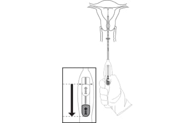 Illustration shows how to release the IUD and withdraw the inserter after the final position is reached.