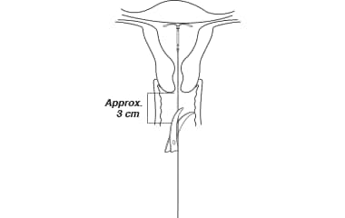Illustration shows how to cut the threads after IUD insertion.