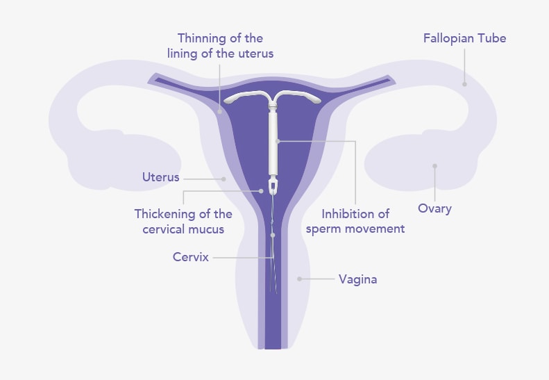 Kyleena® (levonorgestrel-releasing intrauterine system) 19.5 mg IUD mechanism of action graphic.